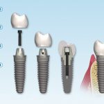 What are the parts of a dental implant?