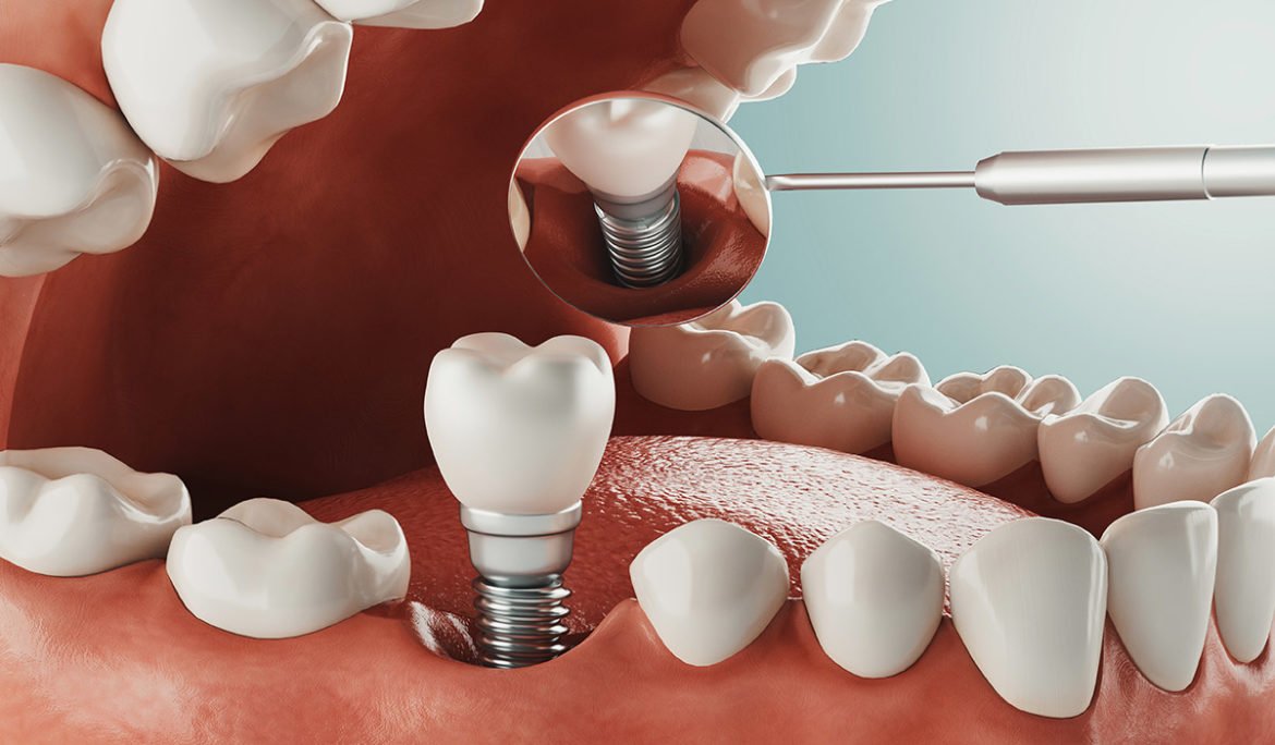 Is Dental Implants in China Very Expensive?