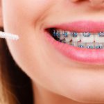 4 Helpful Tips to Survive Your First Week With Dental Braces – Our Guide