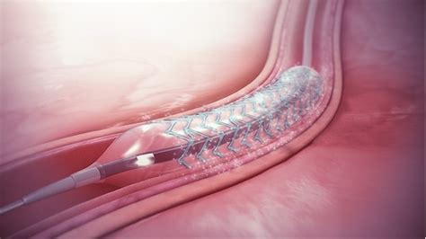 Drug Eluting Stent – The Savior of Your Heart Beats