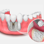 Dental Bone Grafts