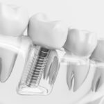 Dental Implants in Grand Prairie