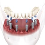 Full Mouth Dental Implants