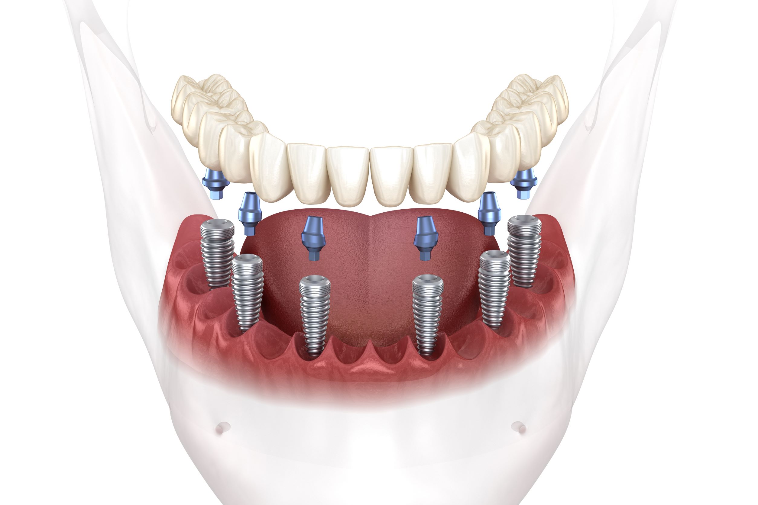 Full Mouth Dental Implants