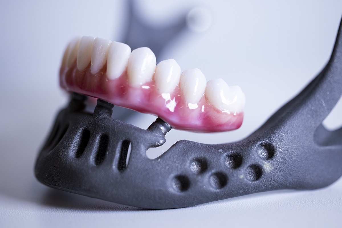 Types of Dental Implants