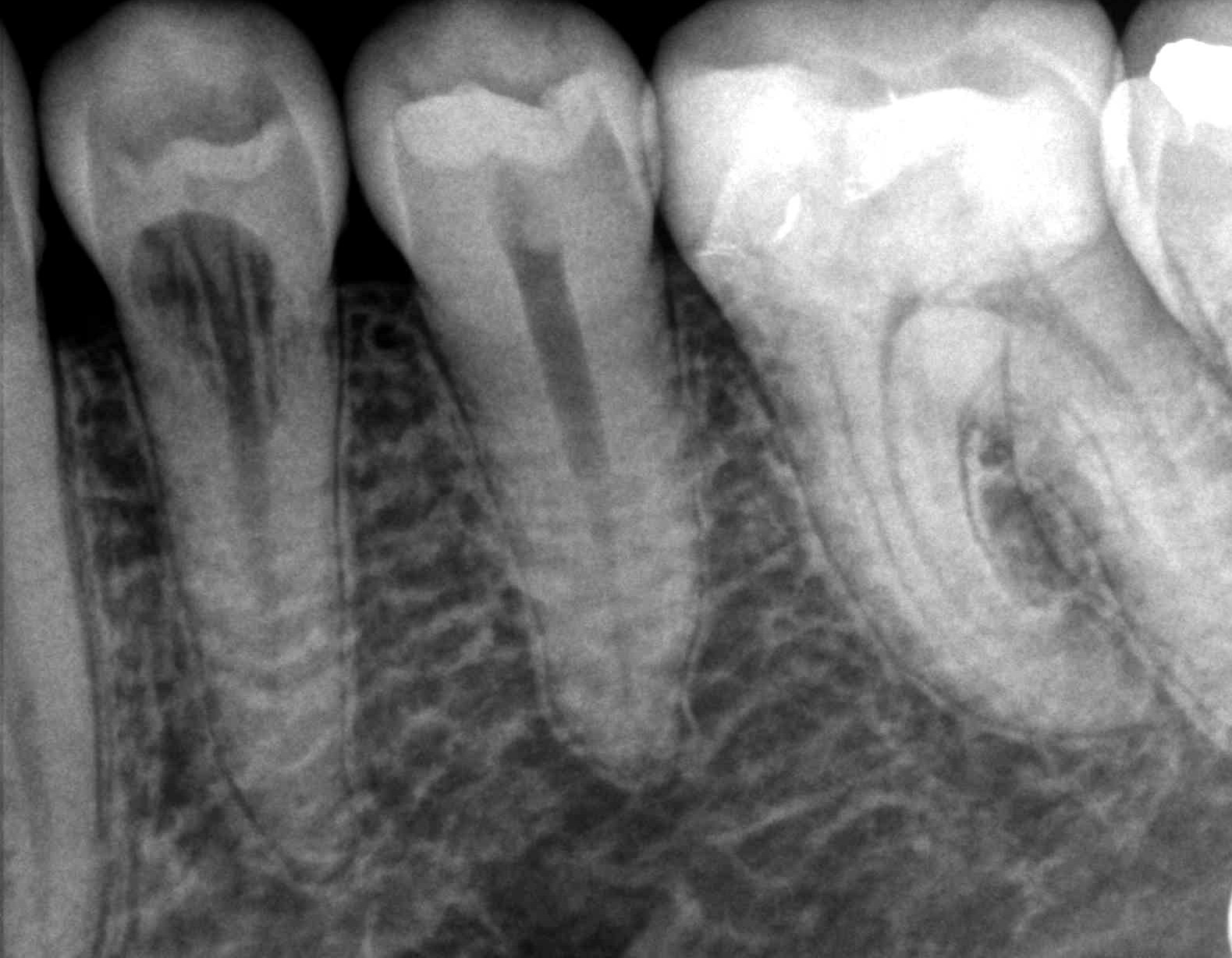 Root Resorption