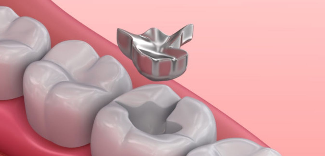 Dental Amalgam