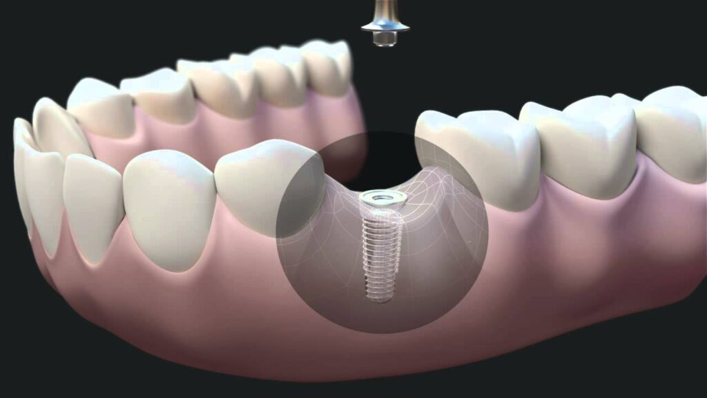 Dental Implant Procedure