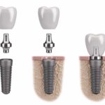 Dental Implants 1