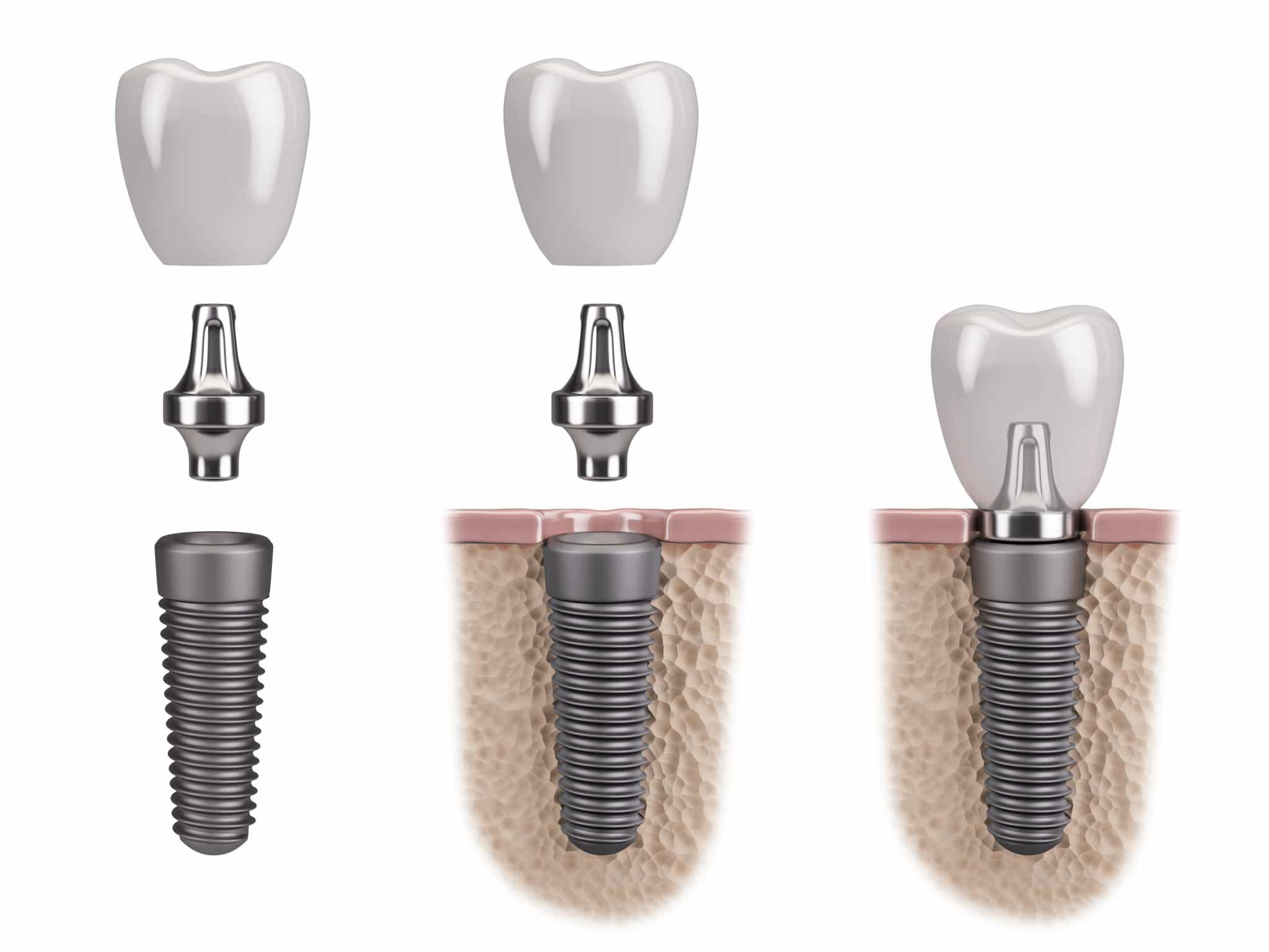 Dental Implants 1