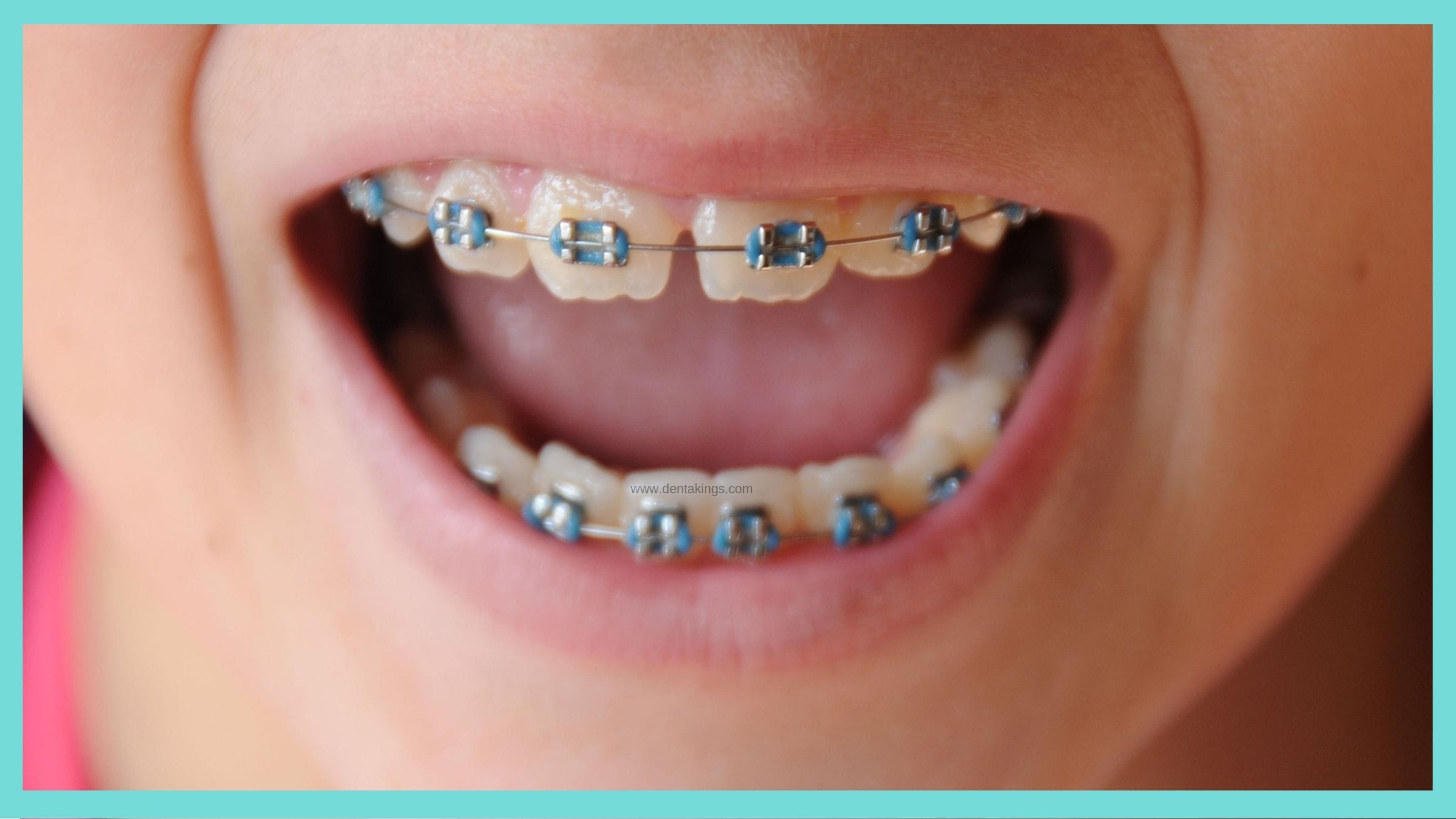 Dental Orthodontic