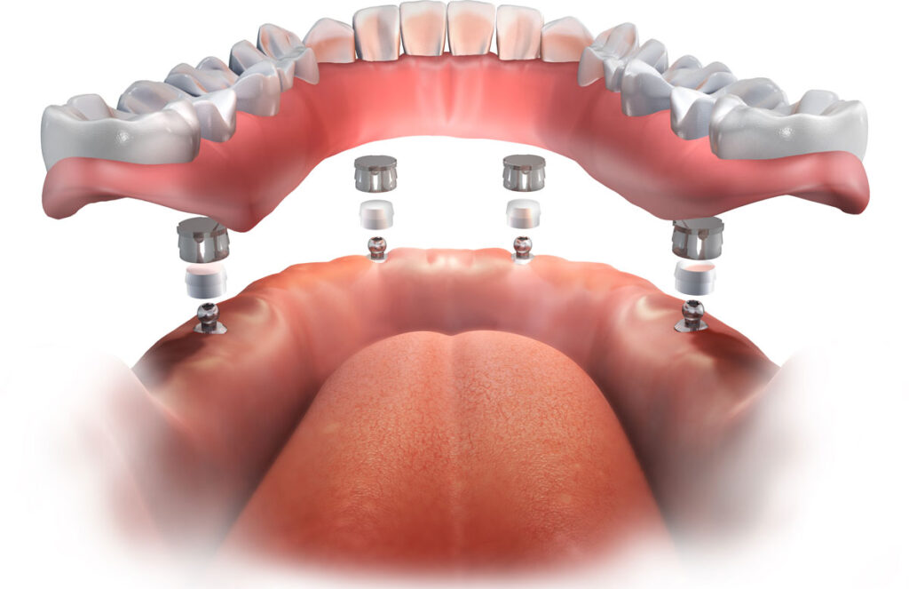 All on 4 Implant Configuration