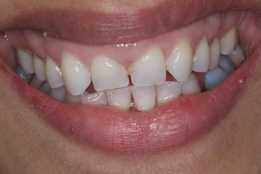 Before and after dental bonding for closing gaps