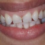 Before and after dental bonding for closing gaps