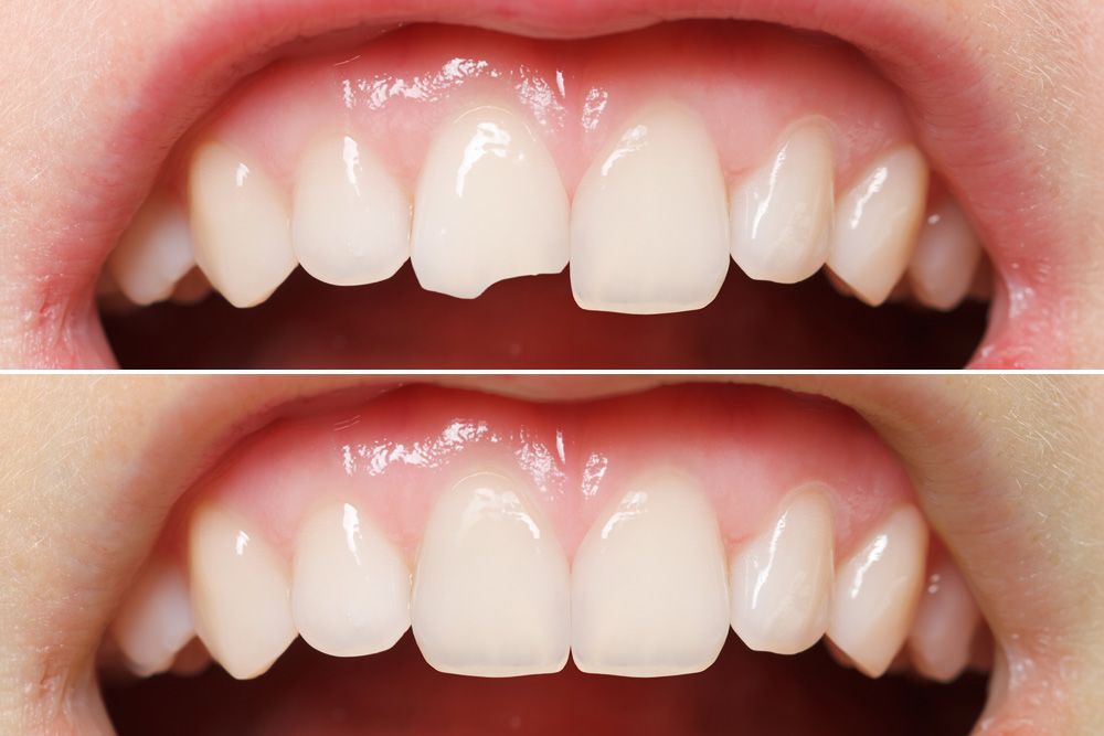 Before and after dental bonding for reshaping teeth