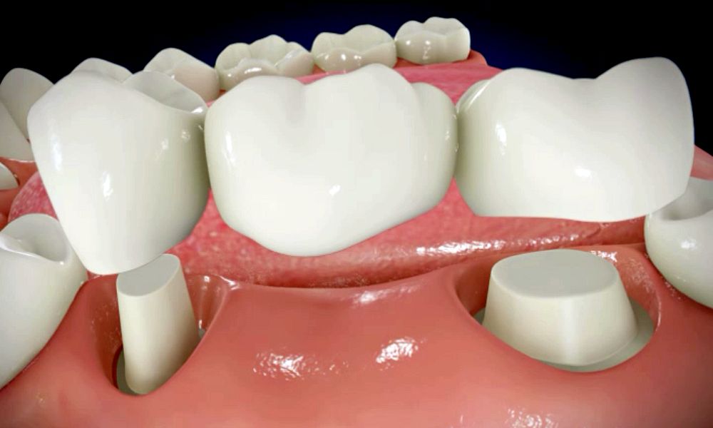 Dental Bridge Components