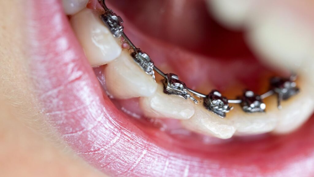 Lingual braces