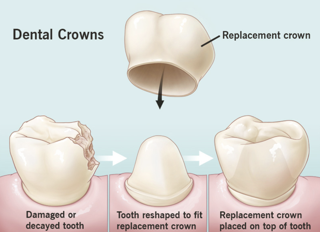 Dental Crown