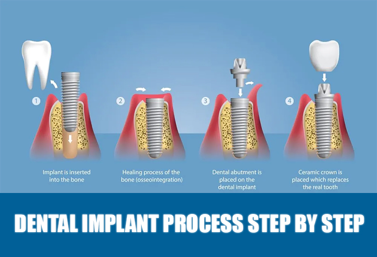 Dental Implants