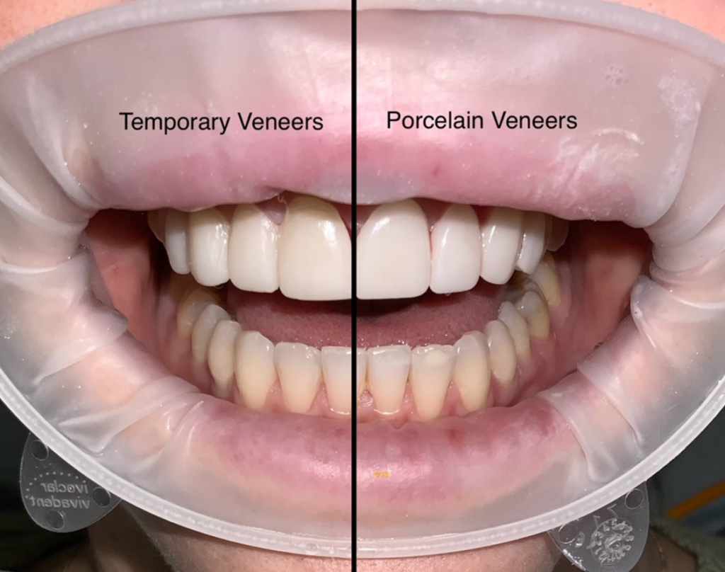 Dental Veneer Procedure