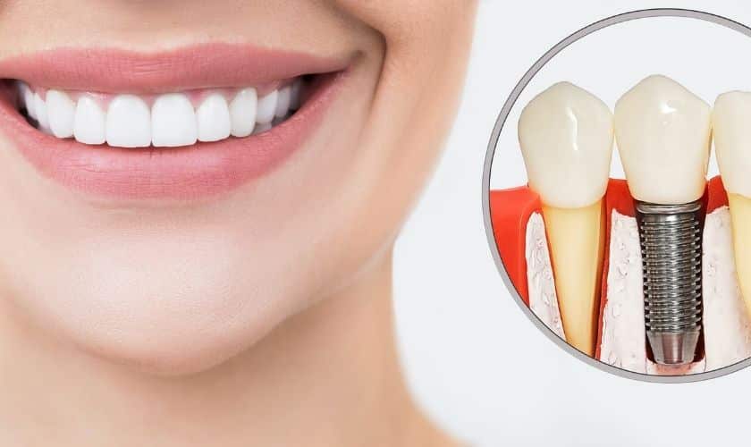 average lifespan of dental implants