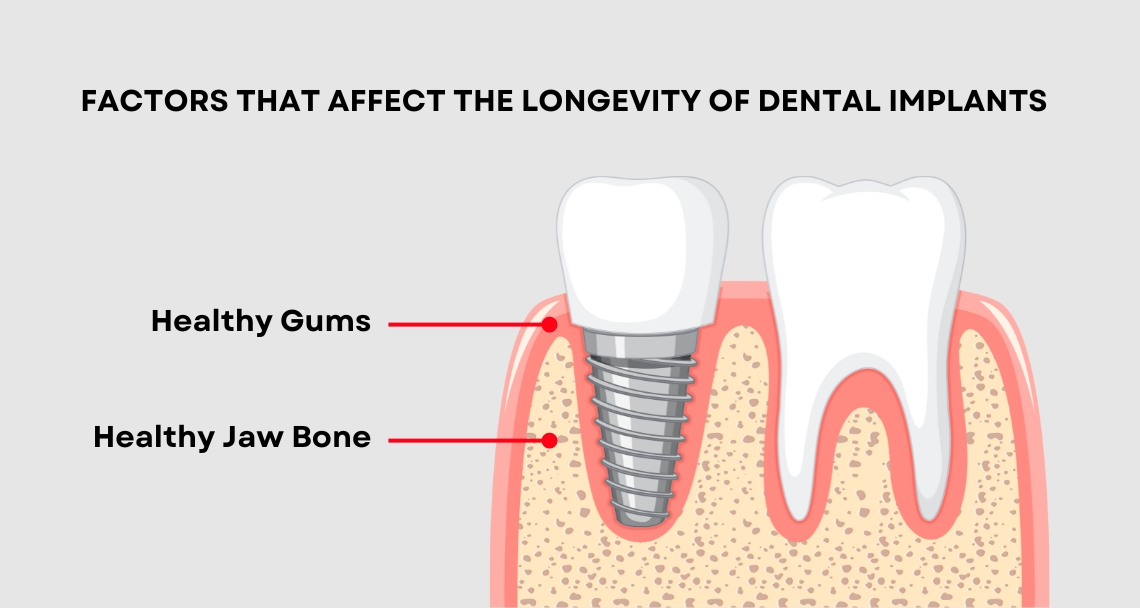 Longevity of Titanium Dental Implants