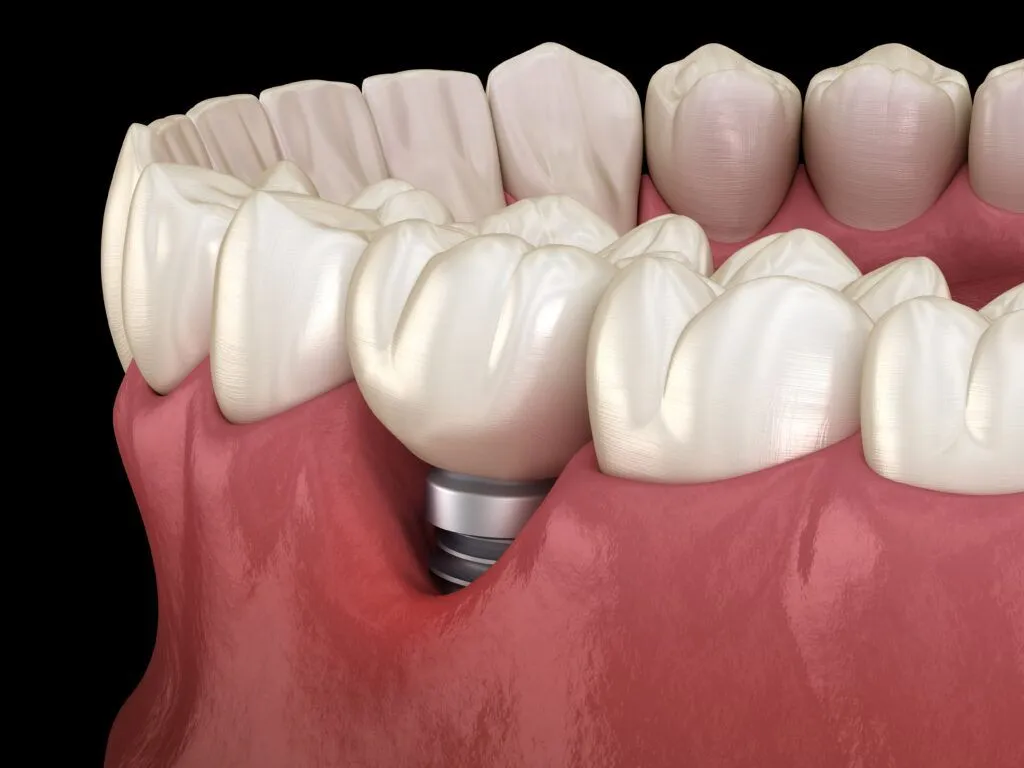 Titanium Dental Implants