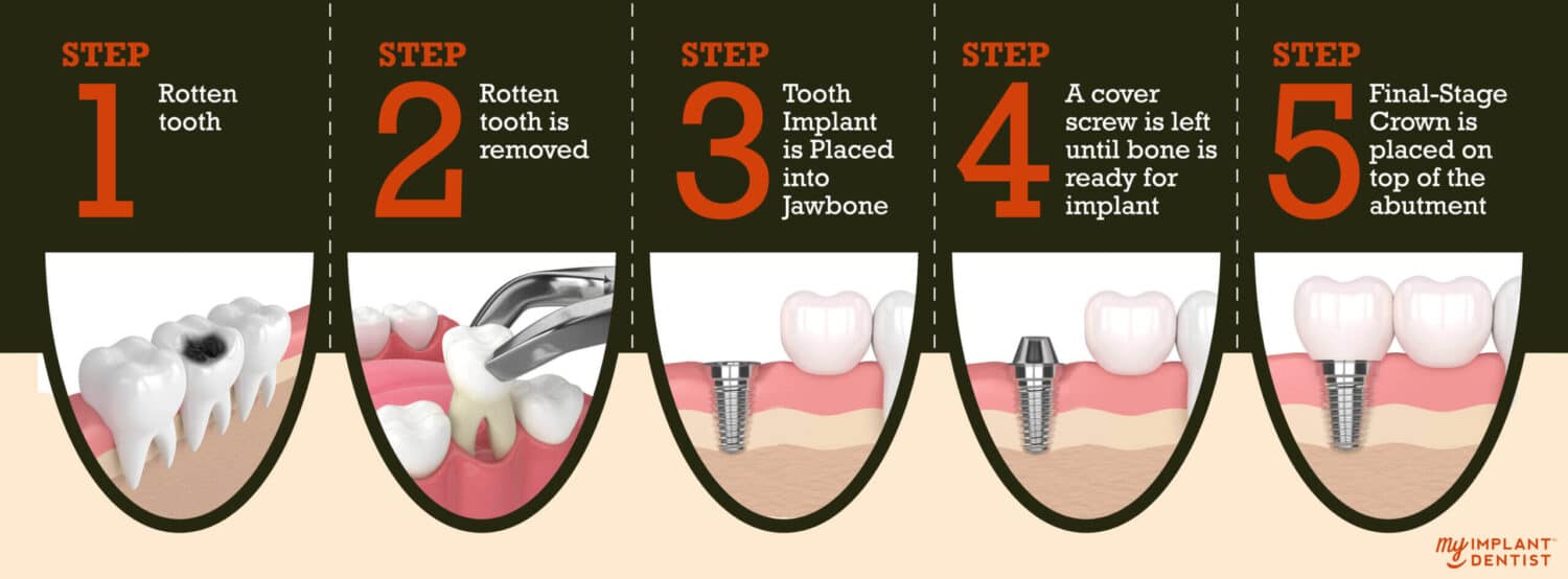 Traditional Dental Implants