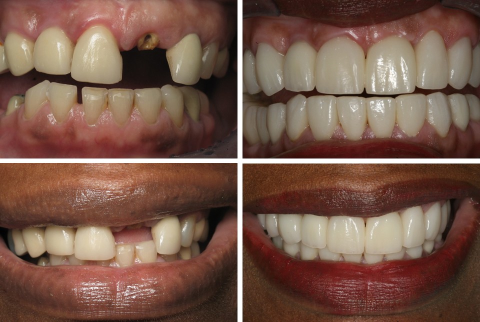 Transformation With ClearChoice Dental Implants