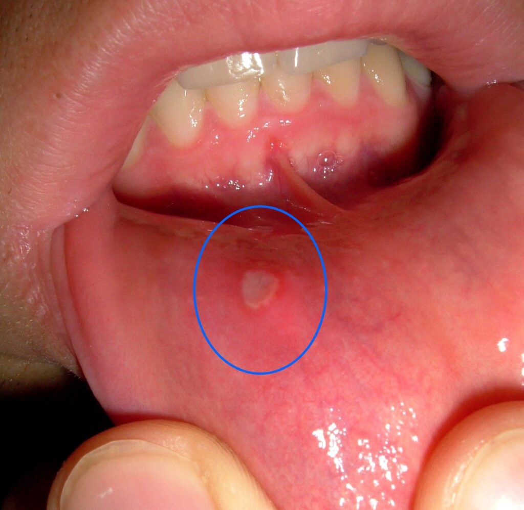 Canker Sores