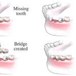 Dental Bridge Procedure