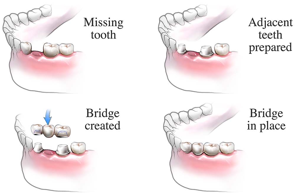 Dental Bridge Procedure