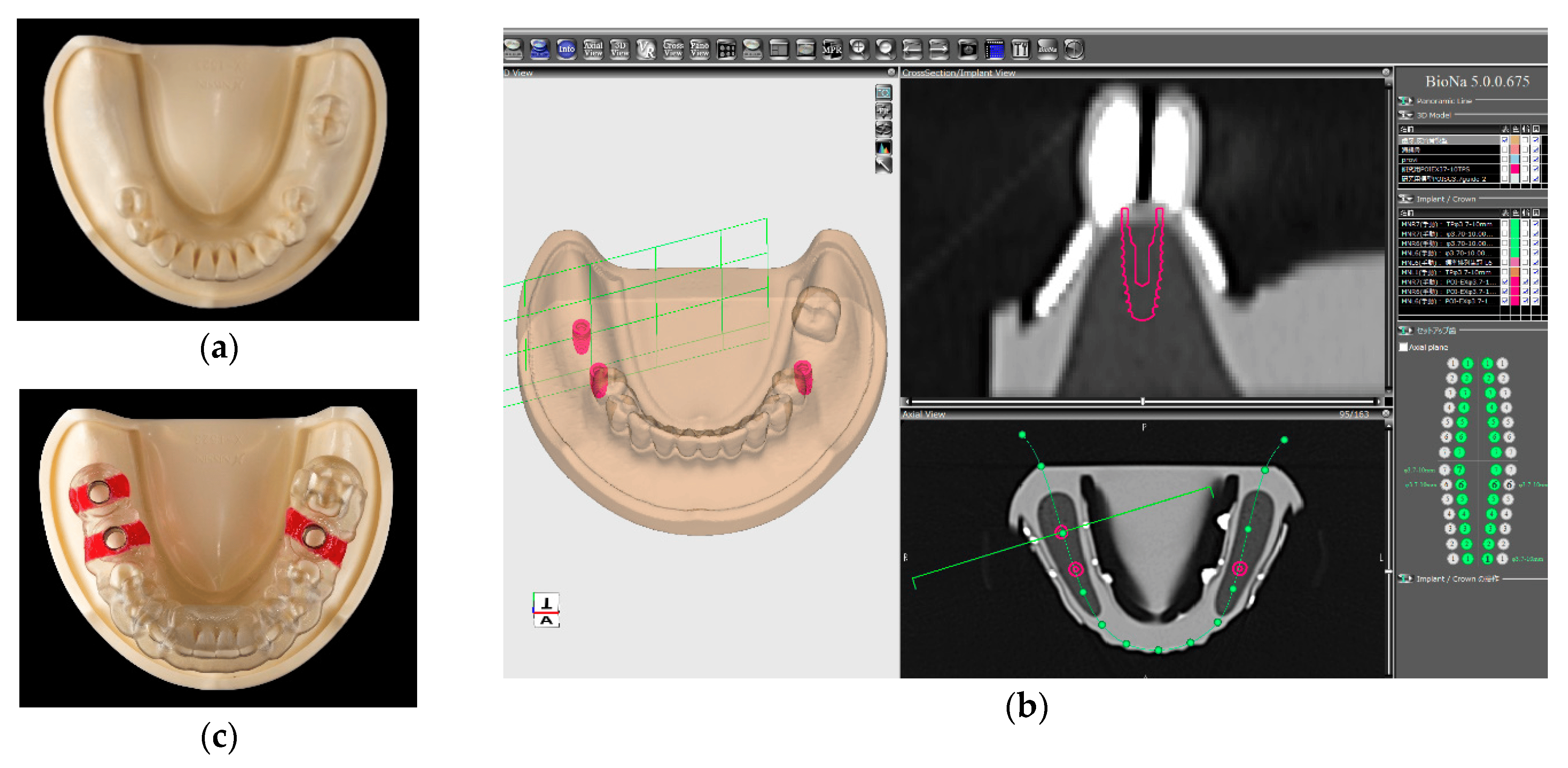 Dental Implant Surgery