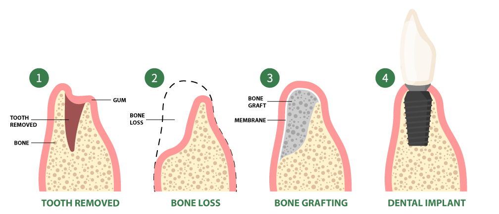 Types of Dental Bone Grafts