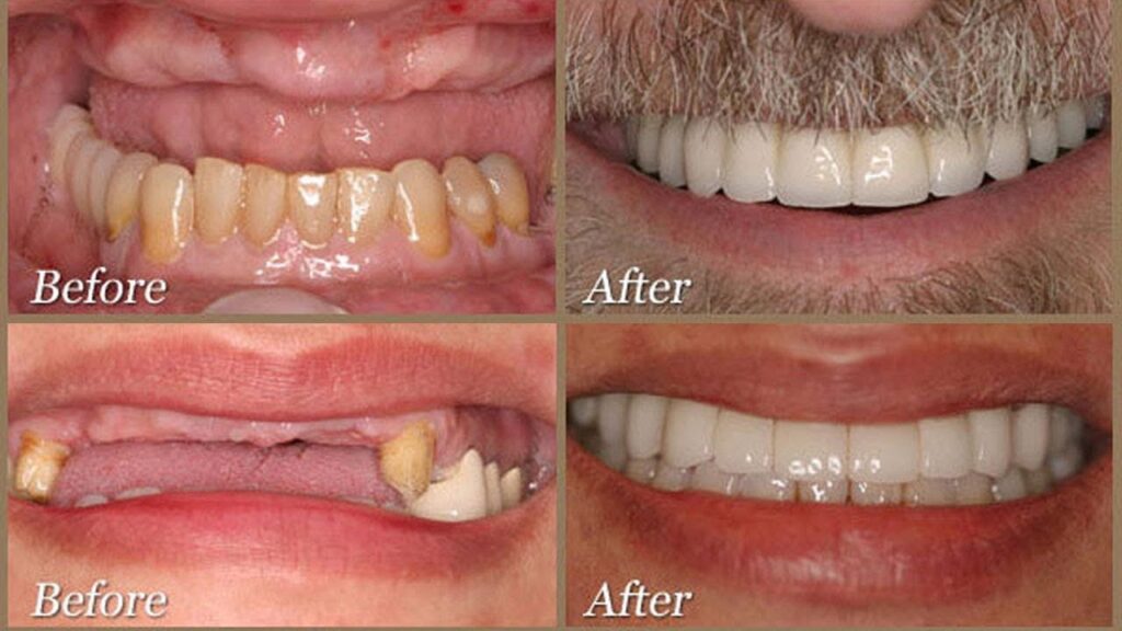 clear choice dental implants before after