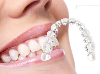 Accelerated Orthodontics