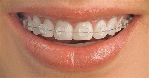 Ceramic Braces