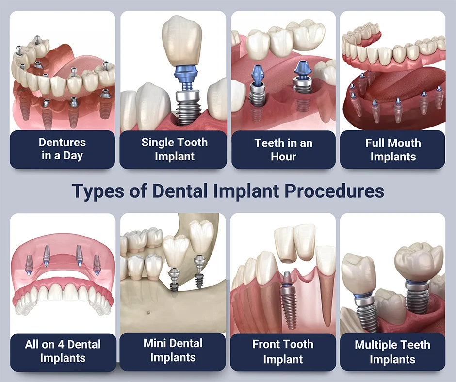 Dental Implant Surgery Procedure