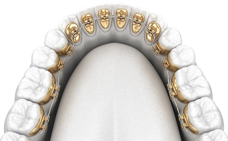 Lingual Braces