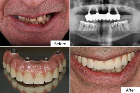 Before and After Images of All on 4 Patients